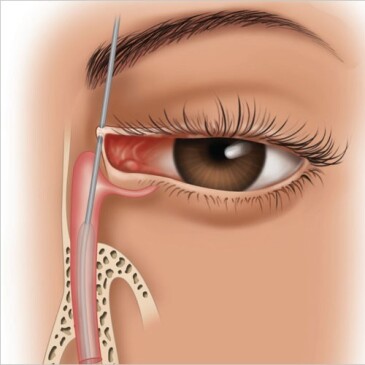 جراحی انسداد مجرای اشکی 