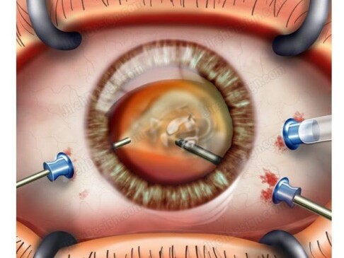 جراحی در بیماریهای شبکیه شامل جداشدگی پرده چشم و خونریزی داخل چشمی 