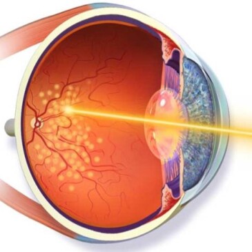 انجام لیزرهای چشمی